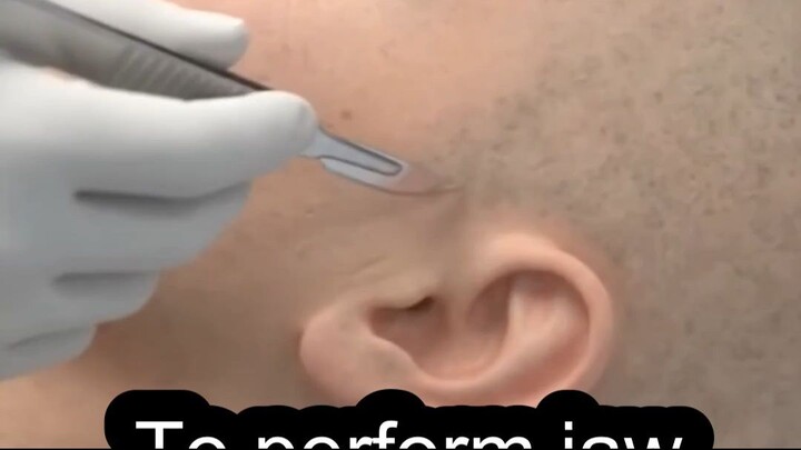 To perform jaw joint replacement surgery #Jaw #Joint #Replacement #Surgery #Doctor