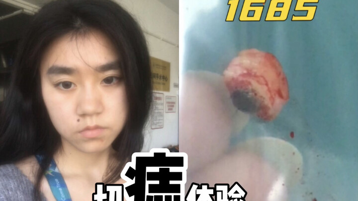 Cuối cùng cũng cắt bỏ nốt ruồi mai mối ở khóe miệng rồi