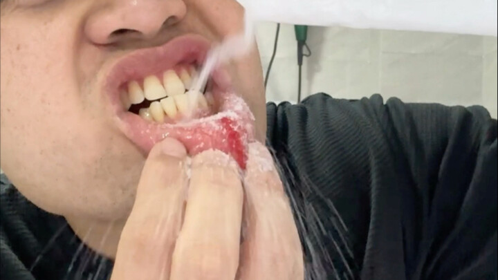 Quick Tips for Mouth Ulcers