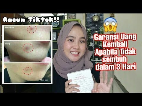 RACUN BARU UNTUK PEJUANG JERAWAT !!