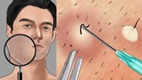 [ASMR] 사각사각 면도소리 + 인그로운헤어 뽑기 / Shaving sound + ingrown hair removal animation