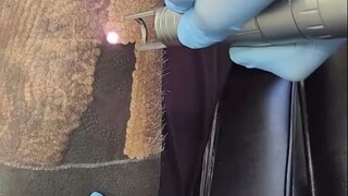 用激光去除大面积黑色纹身，怎么有种烤猪皮的既视感...