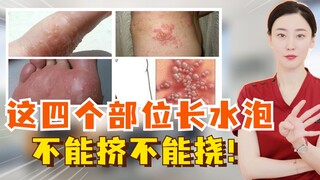 لا تقم أبدًا بعصر أو خدش هذه الأماكن الأربعة التي تظهر فيها البثور!