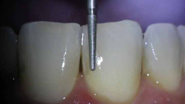 desgaste dental