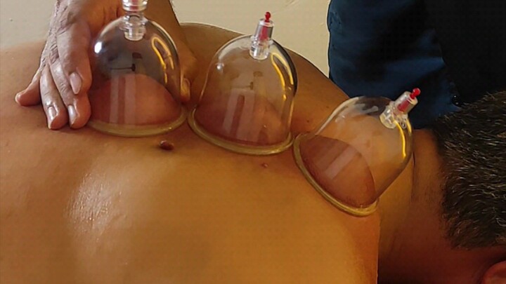 cupping