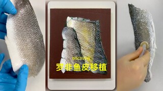 来了解一下罗非鱼皮移植
