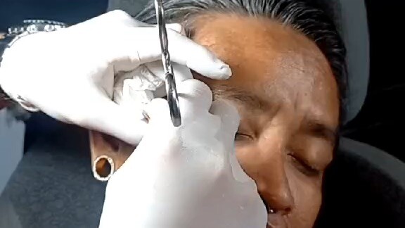 Microdermal piercing