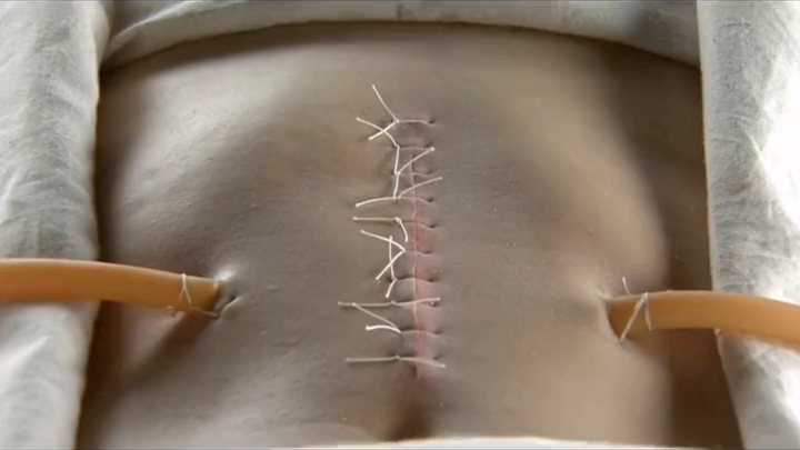 Ren Yi: Dokter Modern di Zaman Kuno Melakukan Operasi Perut pada Pasien, Membuat Rekan Dokter Zaman 