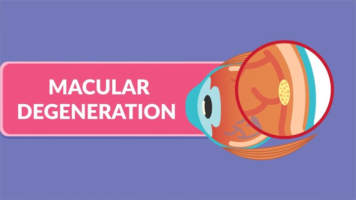 Macular degeneration