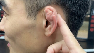 หูไม่ใช่ความผิดปกติ แต่เกิดจากการล้ม (เรียกสั้นๆ ว่า หูเกี๊ยวซ่า)