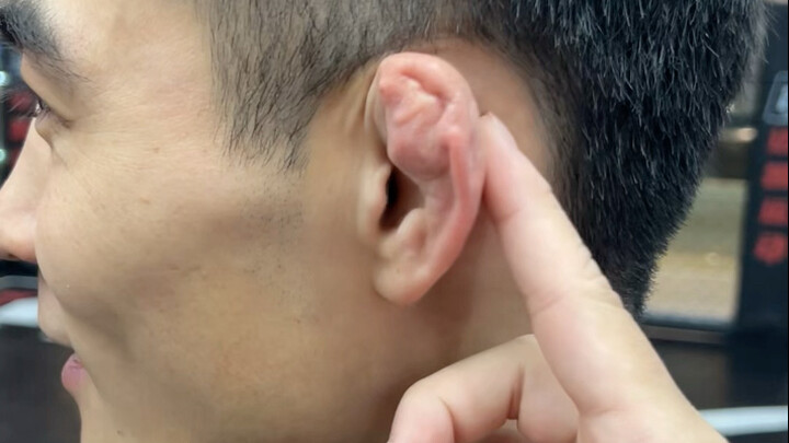 耳朵不是畸形 是摔跤形成的（俗称：饺子耳）