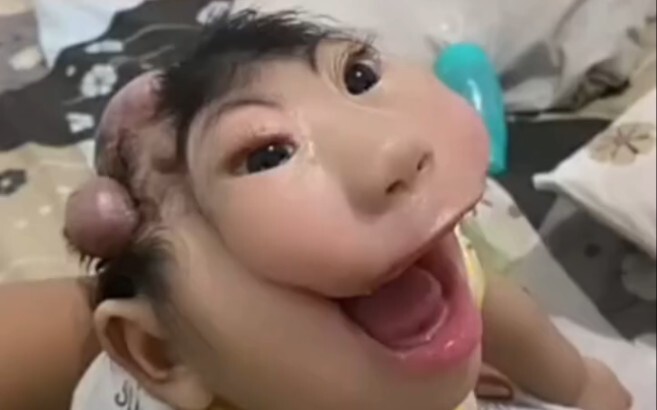 โรคหายาก!