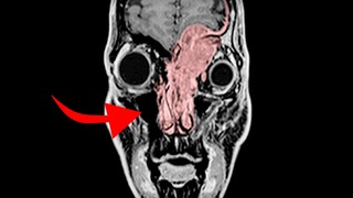 "They kept saying my headache was just sinusitis..."