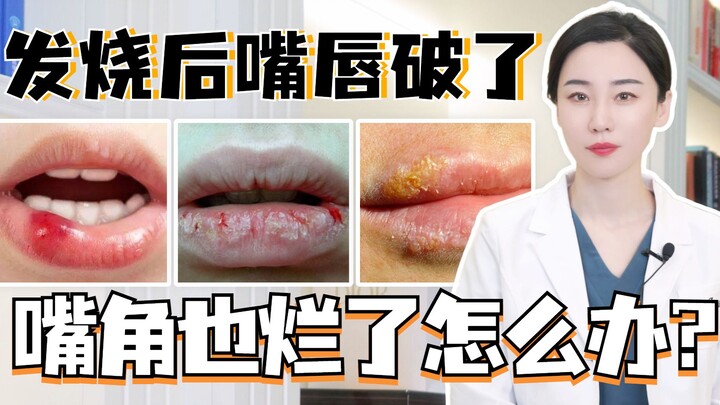 Setelah demam, bibir jadi pecah-pecah dan sudut mulut juga luka. Harus bagaimana?