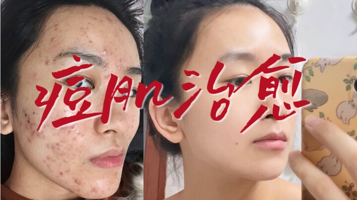 A decade-long, tearful battle with acne—only after my face was wrecked do I have the right to talk a