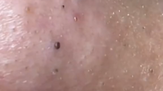 简单清理小毛孔