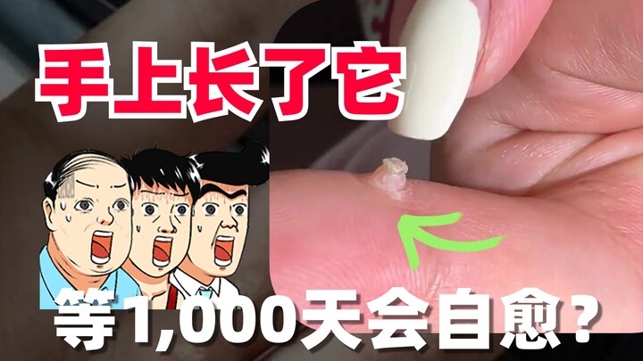 【Penjelasan Medis】Pertanyaan: Benjolan daging di tangan, apakah akan sembuh sendiri setelah 1.000 ha