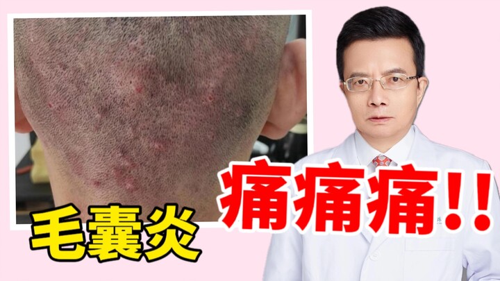 มีตุ่มแข็งขึ้นบนศีรษะ ทั้งเจ็บทั้งบวม! อย่าไปรักษาเหมือนสิวอีกเลย