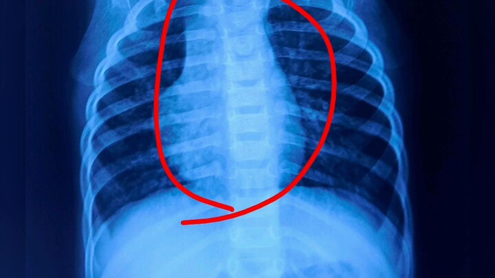 Why Is the Heart on the Right Side on a Chest X-Ray? What Is Dextrocardia and How Is It Identified?