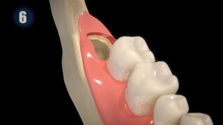 Wisdom Teeth Extraction - Step by step#WisdomTeethExtraction #DentalSurgery