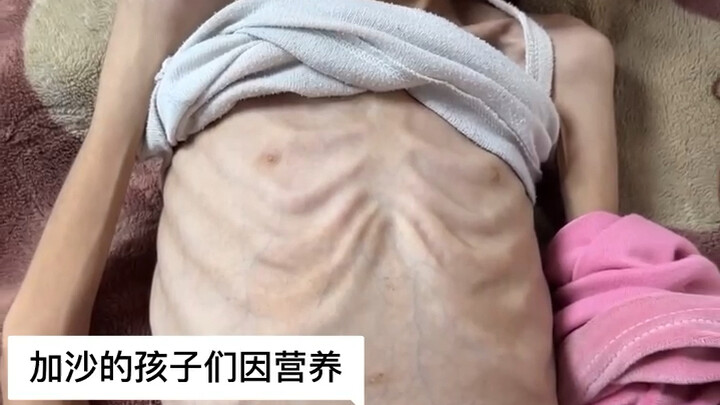 Malnourished children in Gaza... and their frailty.