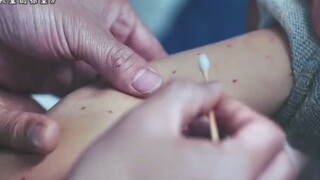Mũi cô bé chảy máu không ngừng. Khi bác sĩ nhìn thấy cánh tay cô bé đầy những đốm đỏ, ông lập tức nh
