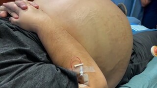 Đã hút được 19 lít dịch cổ trướng! Thật không thể tin được!