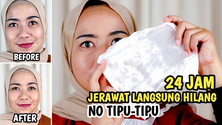 REVIEW BEUDELAB ANTI ACNE LOTION NO TIPU-TIPU