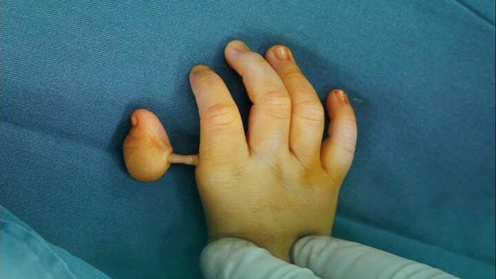 Ngón cái “treo trên sợi tóc”, phẫu thuật chuyển đổi ngón trỏ thành ngón cái để tái thiết lập chức nă