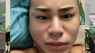 I'm disfigured! This is what I look like five days after a hair transplant.