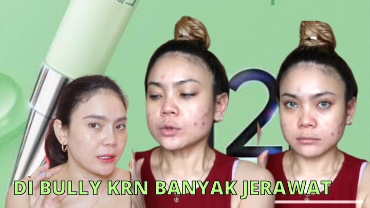 UMUR 40 MASIH JERAWATAN | SALICYLIC ACID MASIH JADI ANDALAN