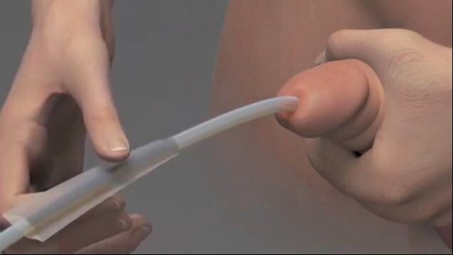 Transurethral resection of the prostate (TURP)