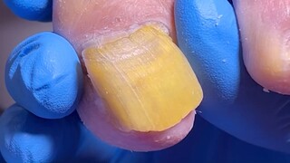 There is a yellow shell on the outside of the toenails, cut it clean!