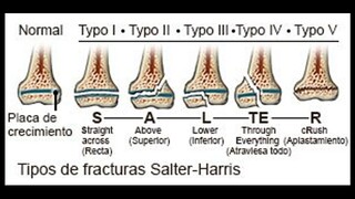 Fractura Salter y harris