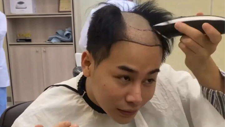 Aku lagi-lagi melakukan transplantasi rambut! (Vlog transplantasi rambut kali kedua setelah kegagala