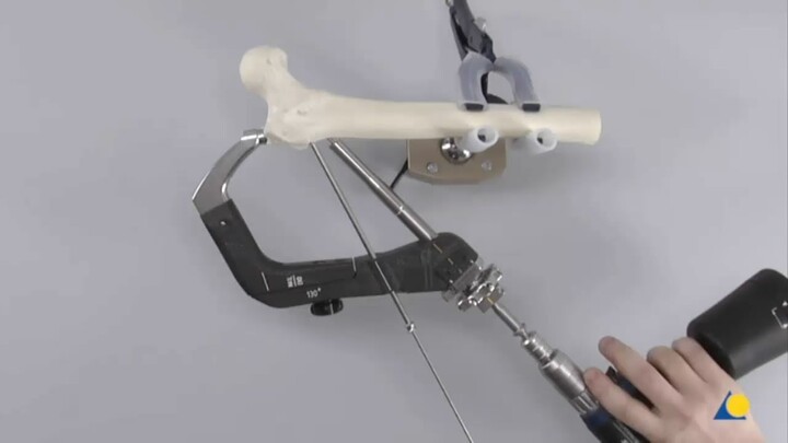 Intramedullary Fixation using the Advanced Proximal Femoral Nailing System TFNA