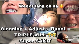 8 MONTHS BRACES UPDATE!  "PART 1" (UMAYOS NA!) | Jamaica Galang