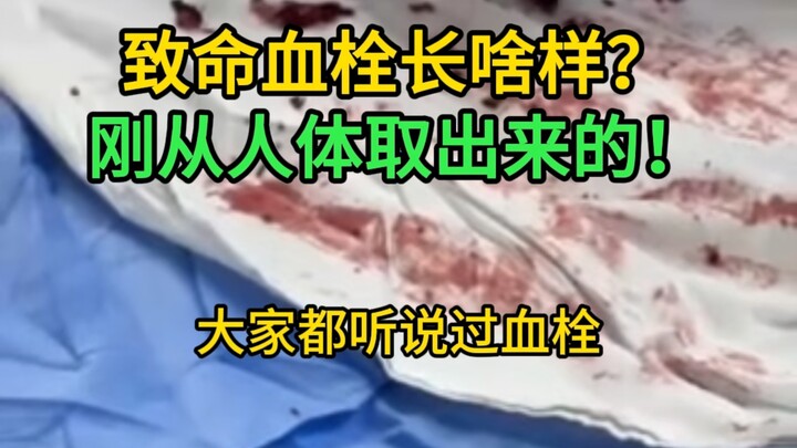 Seperti apa bentuk gumpalan darah yang mematikan? Video ini menampilkan gumpalan darah asli, yang mu