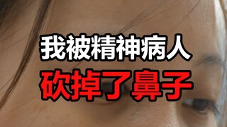 Mũi tôi bị bệnh nhân tâm thần cắt đứt