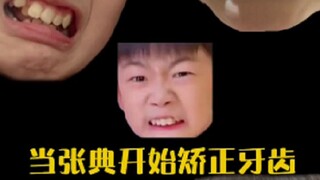 张典矫正牙齿的心路历程#晨晨典典