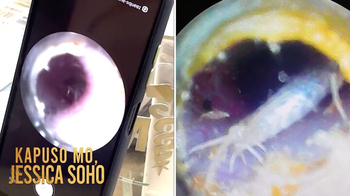 29-anyos, napasukan ng insektong may galamay sa tenga habang natutulog!  | Kapuso Mo, Jessica Soho