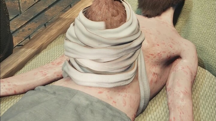 They used chicken butts to treat wounds.