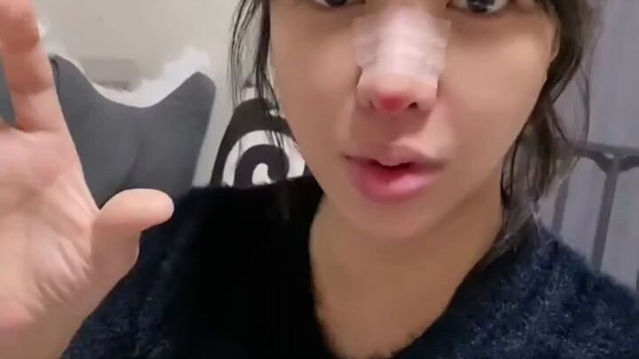 Finally got rid of this terrible nose!