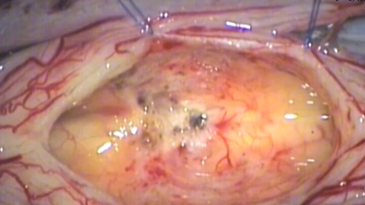 جراحة استئصال ورم الحبل الشوكي (فيديو جراحي، يُنصح غير المتخصصين بعدم الدخول)