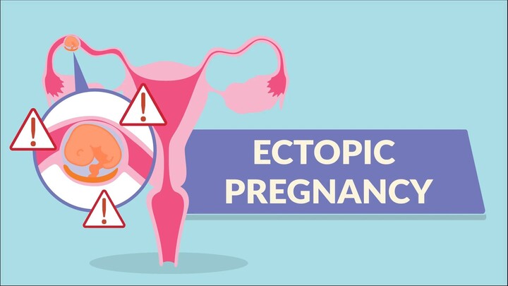 Ectopic Pregnancy