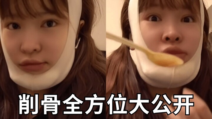 สาวญี่ปุ่นผ่าตัดตัดกระดูกกราม เผยแพร่แบบเต็มๆ! 【โกโชอิฮารุ】