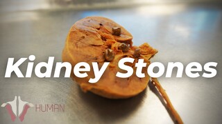 The Most PAINFUL Thing a Human Can Experience?? | Kidney Stones