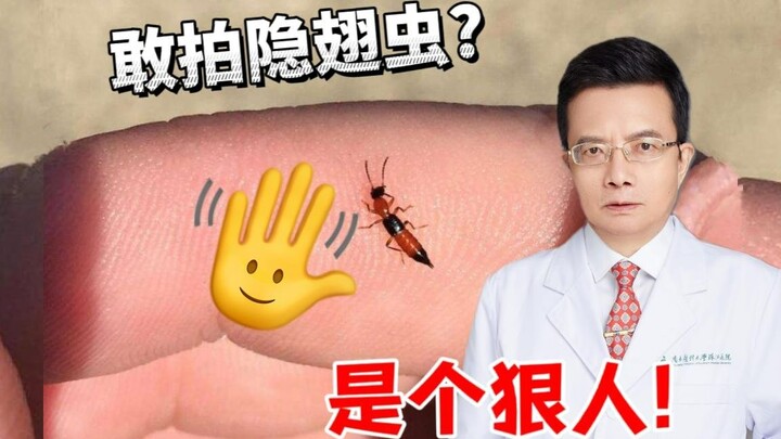 Nọc độc của loài bọ này nguy hiểm không kém axit sulfuric, tuyệt đối đừng làm thế khi chạm phải chún