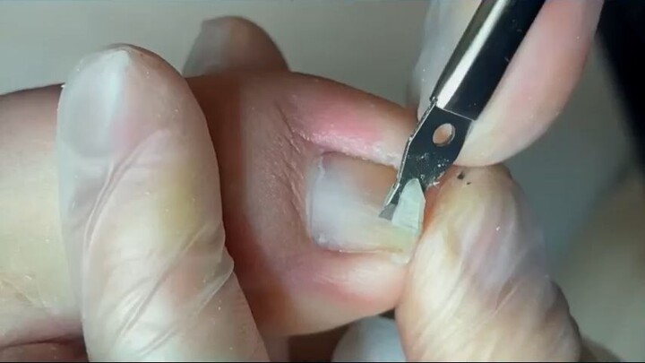 Satisfying and profession toenail treatment_R