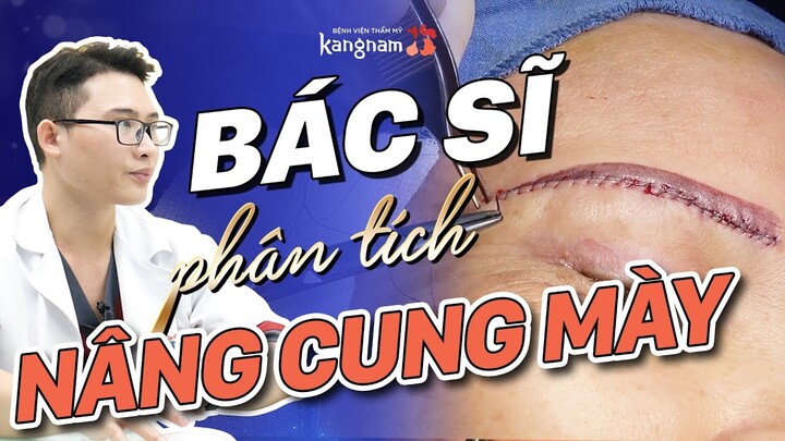 Bác sĩ phân tích kỹ thuật Nâng cung chân mày